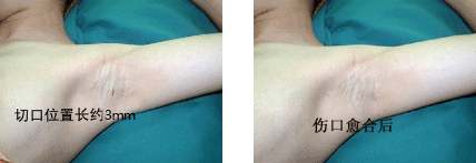 治疗腋臭改良小切口汗腺清除术前后对比.GIF